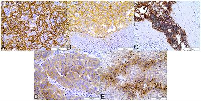 The Warburg Effect Is Associated With Tumor Aggressiveness in Testicular Germ Cell Tumors